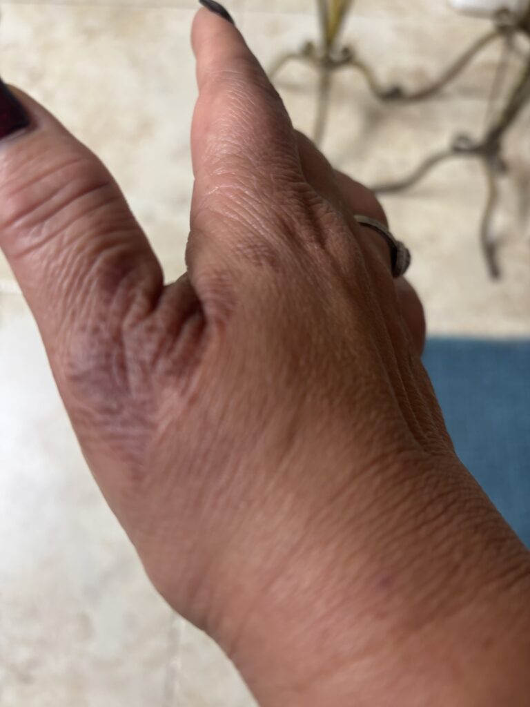 Hands — 10 days — after using Novopiel
