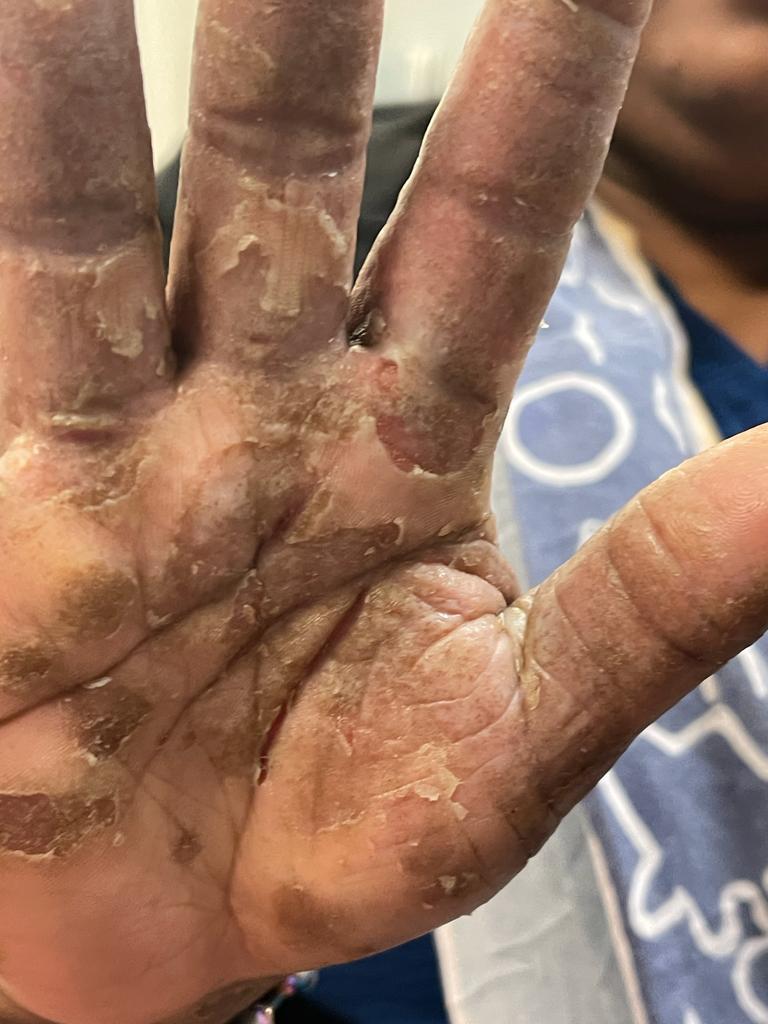 Hands — 4 weeks — before using Novopiel