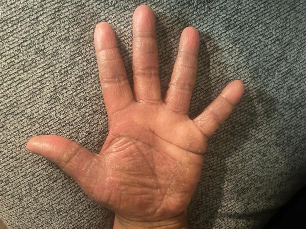 Hands — 4 weeks — after using Novopiel