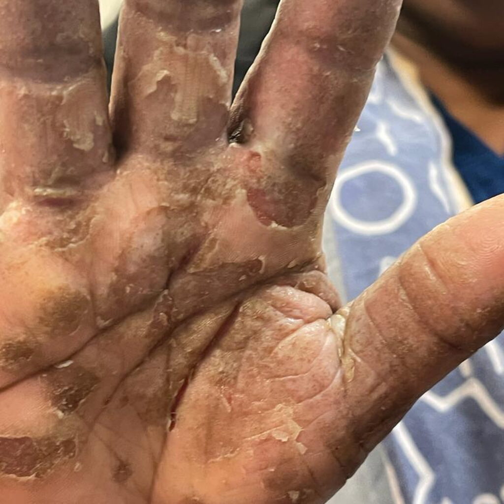 Contact dermatitis — before using Novopiel