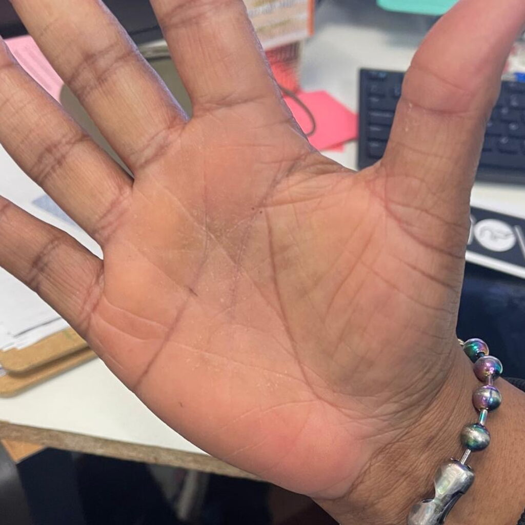 Contact dermatitis — after using Novopiel
