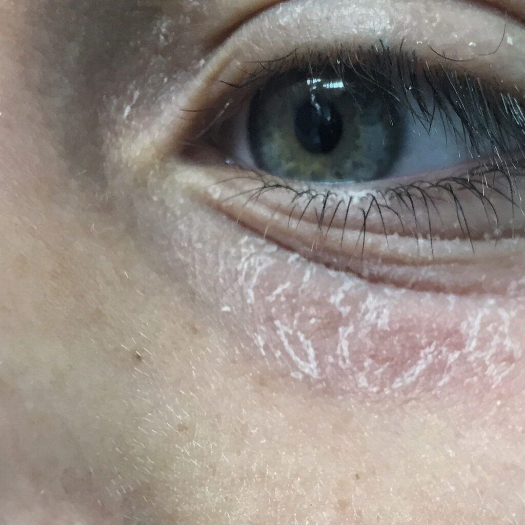 Eczema — before using Novopiel