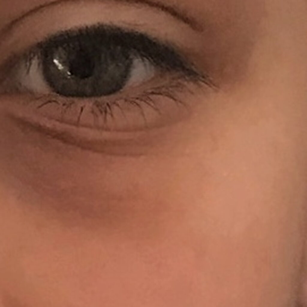 Eczema — after using Novopiel
