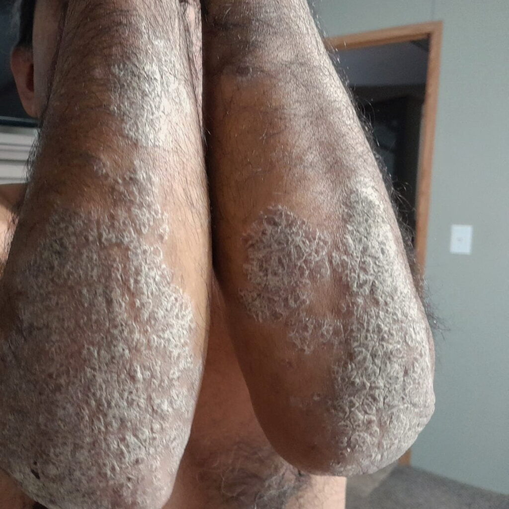 Psoriasis — before using Novopiel