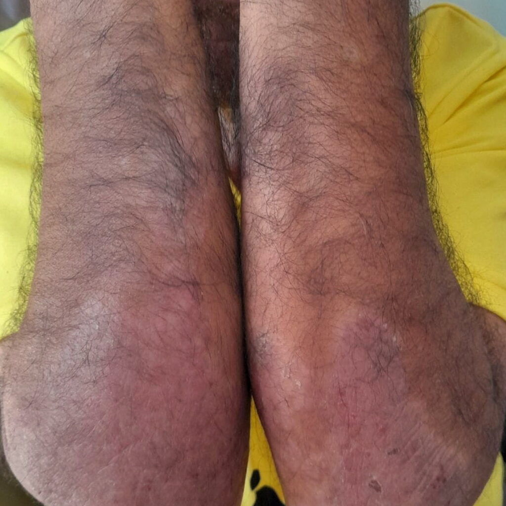 Psoriasis — after using Novopiel
