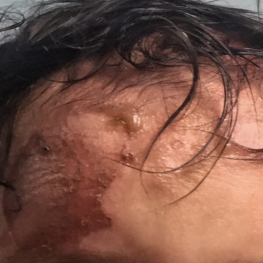 Burn — before using Novopiel