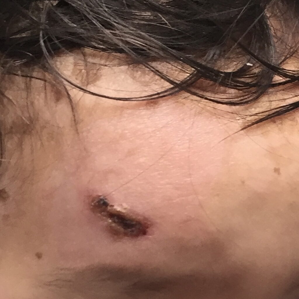 Burn — after using Novopiel