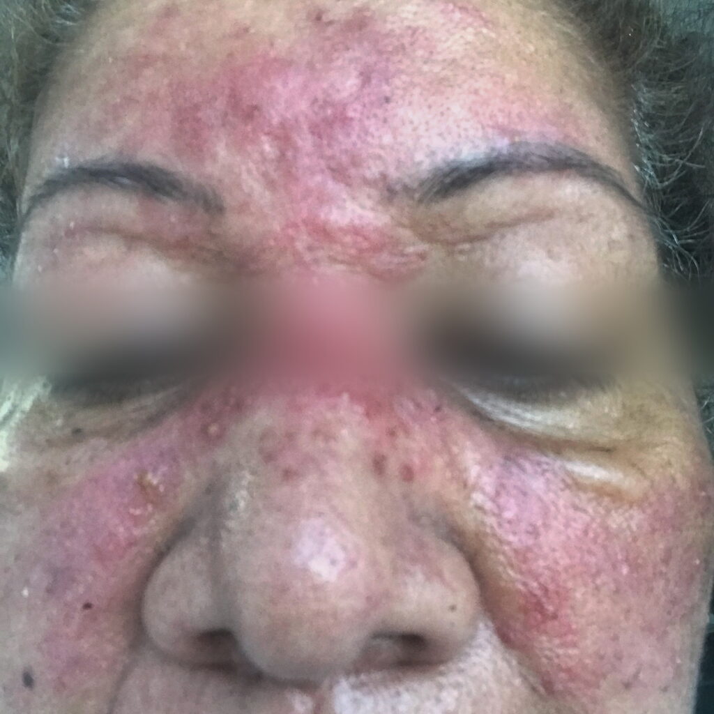 Rosacea — before using Novopiel