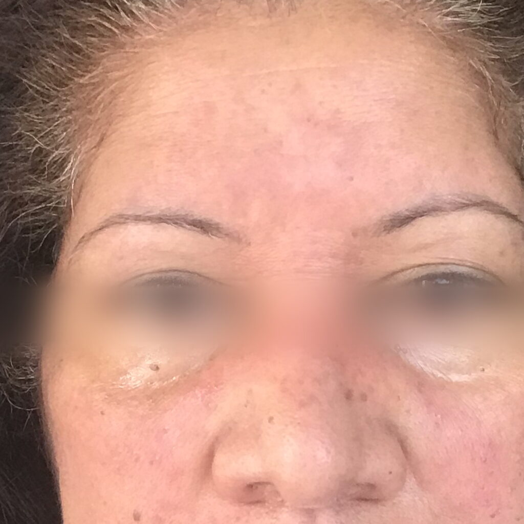 Rosacea — after using Novopiel