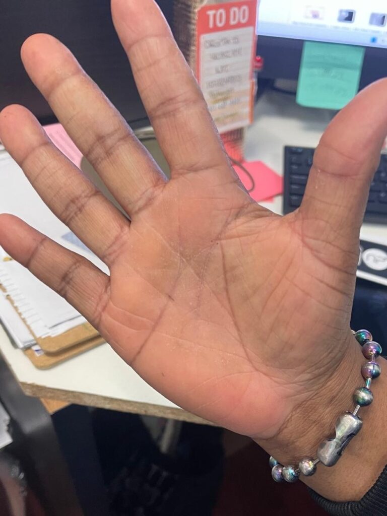 Hands — 4 weeks — after using Novopiel