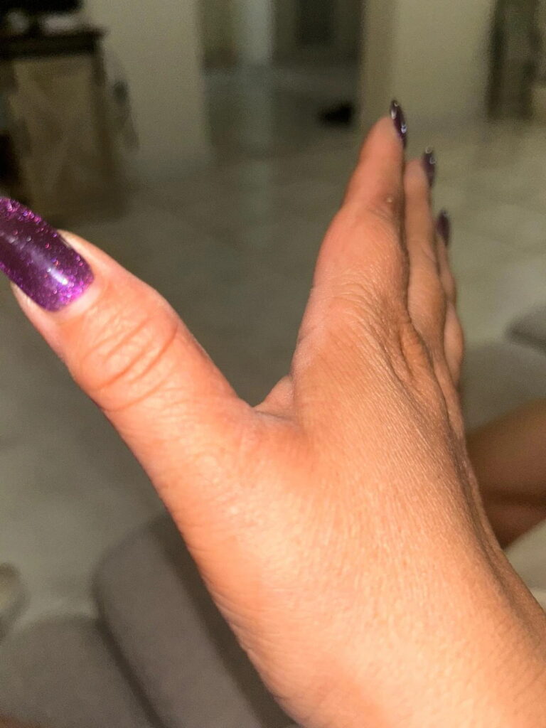 Hands — 10 days — after using Novopiel