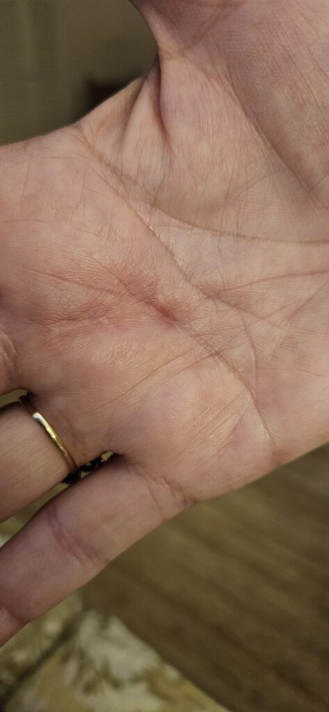 Laceration — after using Novopiel