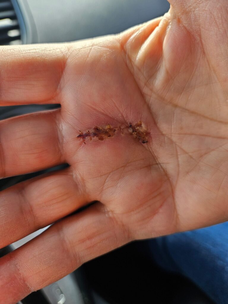 Laceration — before using Novopiel