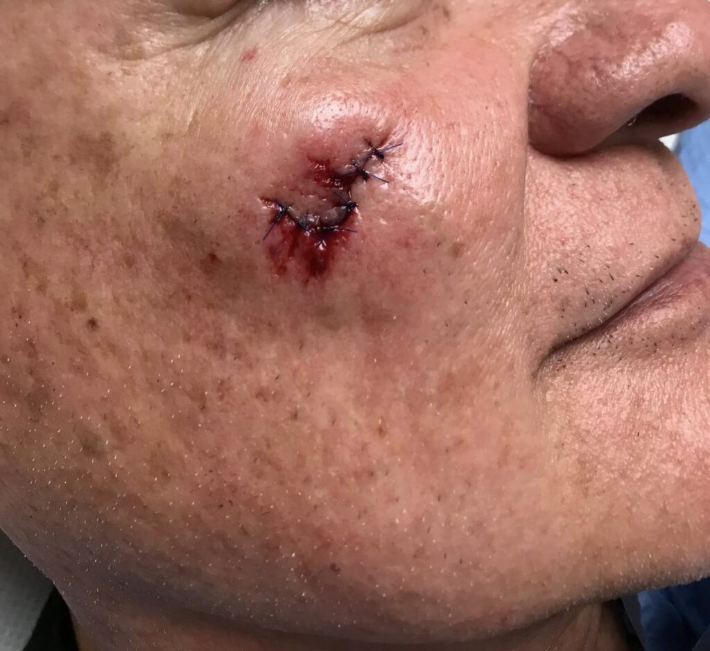 Laceration — before using Novopiel