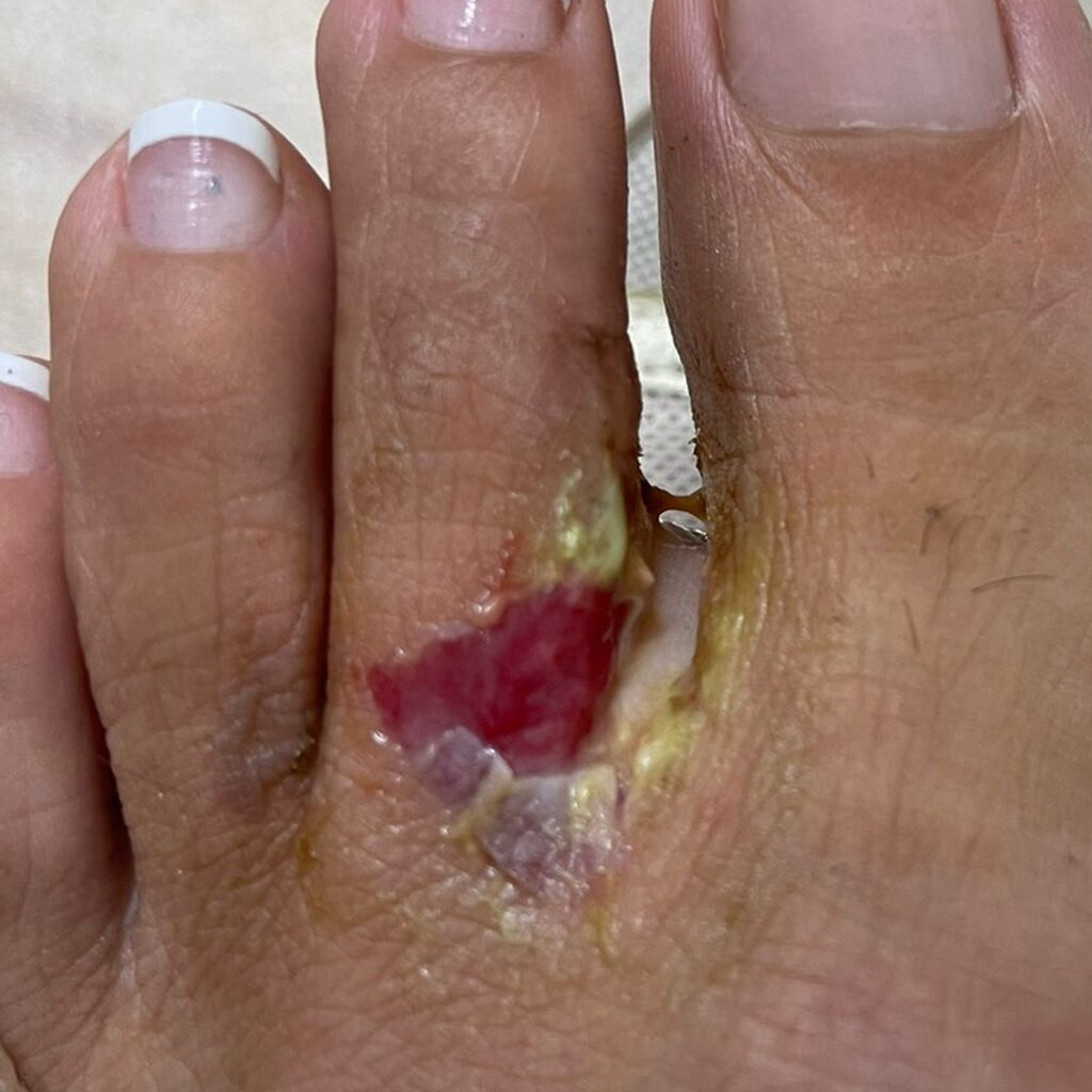 Wax burn — before using Novopiel