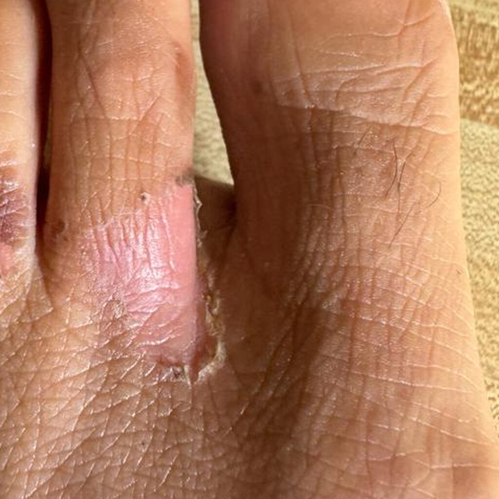 Wax burn — after using Novopiel